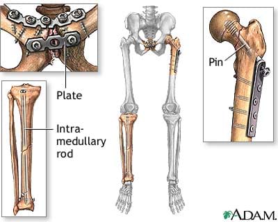 bones fractures