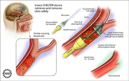 ischaemic stroke most