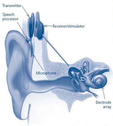 A cut-away drawing of an ear shows placement of the transmitter, speech processor, microphone, receiver/stimulator and electrode array.