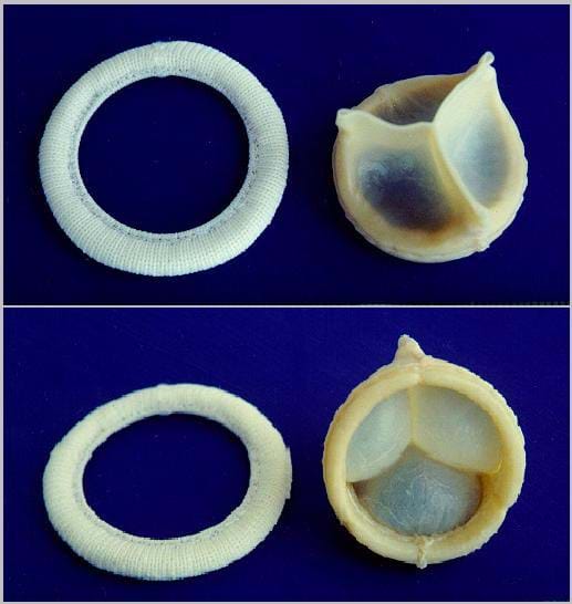 Photos shows the top and bottom views of what looks like a cloth ring and a three-piece funnel-shaped object.