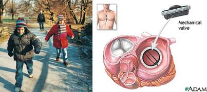 Two images. Two children run in the park. A medical illustration shows a cutaway view of the human heart and an arrow showing placement of a mechanical valve.