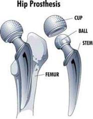 A black and white drawing shows a hip prosthesis components: cup, ball, stem, and where the stem is inserted into the femur.