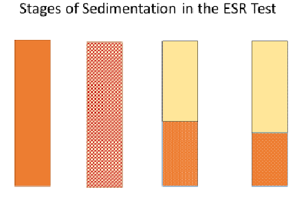 A diagram illustrates the stages of the erythrocyte sedimentation process with four tall rectangles representing ESR tubes containing anti-coagulated blood. From left to right: Tube 1 at 0 minutes shows uniform coloring; tube 2 at 10 minutes shows the erythrocytes have started to aggregate (pretty uniformly); tube 3 at 40 minutes shows the erythrocytes have completely settled to the bottom half of the tube and clear plasma has separated to occupy the top half of the tube; tube 4 at 60 minutes shows the settled erythrocytes completely compacted (by what is called the packing process) into a sediment of erythrocytes, resulting in more than half of the tube being clear plasma above the sediment layer.