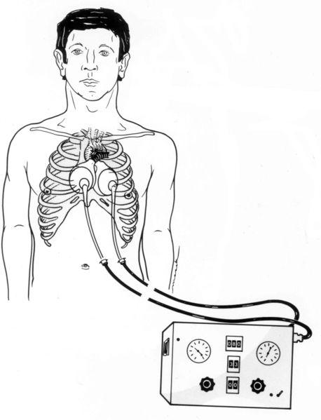 Drawing shows the Jarvik 7 artificial heart implanted in the body, and connected to its external drive system.