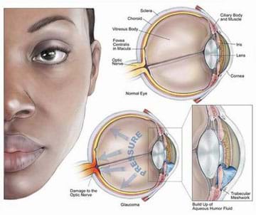 A medical illustration shows the left half of a person's face as if you were looking at her. To the side are three cross-sections of eyes. One provides labeled parts of a normal eye: iris, lens, cornea, optic nerve, fovea centralis in macula, vitreous body, choroid, sclera, cillary boy and muscle. Another similar eye cross-section is amended with the word "pressure," and arrows that point toward the back of the eye to the optic nerve. The final cutaway diagram shows a close-up image of the anterior chamber and a buildup of aqueous humor fluid.
