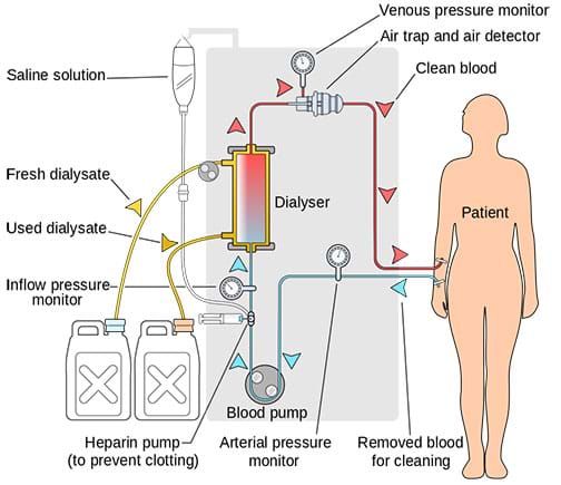 A diagram shows a simplified dialysis treatment circuit. Arrows show the path of blood from a patient, through a blood pump and dialyzer, then back into the person. Fresh and used dialysate containers are part of the dialyzer segment of the process.