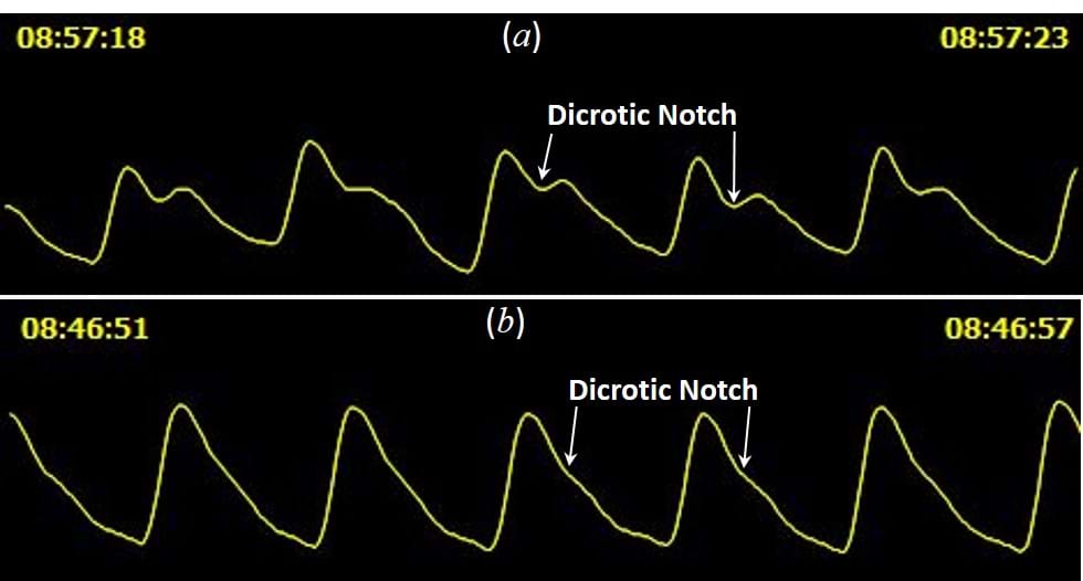 Dicrotic Notch definition on the PPG pulse depends on the age. The younger and cardiovascular healthier the individual, this point will be better defined.