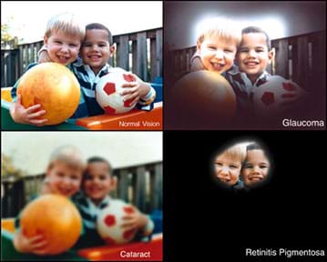 Four images show the same view of two older toddler boys embracing and holding a soccer ball and bouncy ball near a wooden fence. The first image is “normal vision.” The glaucoma version is darkened all around the edges, with only the boys’ heads (in the center) looking like normal vision. The retinitis pigmentosa version is like the glaucoma version with the darkened edges even more pronounced, leaving just the eyes, noses, foreheads and mouths of the kids’ faces visible. The cataract version shows the entire image (no blackened areas), but it is overall fuzzy, not crisp.