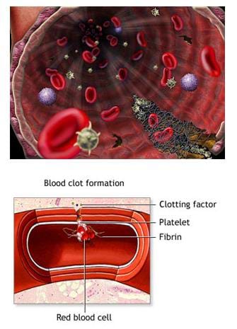 Two medical illustrations of blood clots forming in blood vessels. One identifies a red blood cell, fibrin, platelet and clotting factor. The other image depicts the inside of a blood vessel with the identified elements floating in the blood.