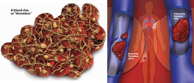 Two medical illustrations: A drawing of a blood clot or "thrombus" shows its components, such as red blood cells, platelets and fibrin. A drawing shows two of the most dangerous blood clots: a deep vein thrombus (DVT), which is a blood clot that forms in a major vein deep inside the body, and a pulmonary embolus (PE), which is a blood clot in the lungs.