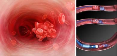 Two medical illustrations show a blood clot (glob of platelets) in a blood vessel, and a tube and wire device in an artery (a cut-away view of the Merci L5 retrieval system, used for clot removal in ischemic stroke patients).