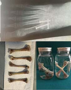 Top: X-ray of a right foot with metatarsal fusion showing three screws; bottom left:  Five chicken bones stripped of meat and arranged on a paper towel; bottom right:  five bones decalcifying in two jars of vinegar, three in one and two in the other.