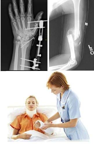 Three photos: An x-ray shows an upper arm bone (femur) broken between the elbow and shoulder. A nurse helps a girl sitting in a bed with a cast on her forearm and support collar around her neck. An x-ray shows a left hand and forearm with internal pins and external devices connecting the palm area to the area above the wrist.