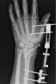 An x-ray shows a left hand and forearm with internal pins and external devices connecting the palm area to the area above the wrist.