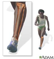 A medical illustration shows a running man and a close-up, see-through drawing of one of his legs from knee to foot, revealing the existence of a tibial intramedullary rod inside to strengthen his shinbone.