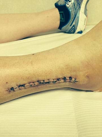 Photo of patient’s ankle post-surgery, shows sutures at the ankle area.