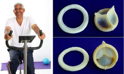 Two images: An older man rides an exercise bicycle. Two photographs show different sides of the mechanical components of a heart valve bioprostheses or "tissue valve," which is an engineered heart valve to replace a diseased valve. This valve prosthesis is made of two parts: a ring (serving as the valve rim, sewn in by the surgeon) and a three-part insert/stent/body (that goes inside the ring/rim).