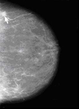 An arrow points to a whitish area in a black and white image, a mammogram.