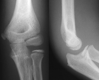 X-ray showing an Ap and laterial of an elbow.