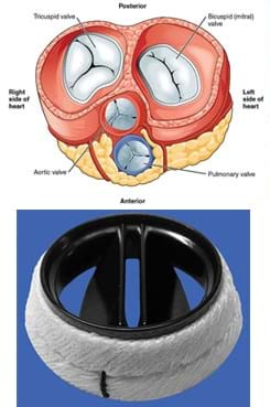 Two images: A cross-section drawing of the heart with the four heart valves identified: tricuspid, bicuspid/mitral, aortic and pulmonary. A photograph of an example engineered artificial heart valve, an Aortic Karboniks-1 bileafter prosthetic heart valve, which looks somewhat like a black plastic top to a coffee cup with finned openings, surrounded by a softer white material. 