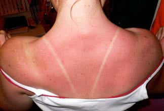 A photograph of a women's back with a sunburn.