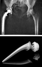 Two images: A black and white x-ray shows a human pelvis with a total hip joint replacement—an artificial "ball and socket" joint. A stainless steel and ultra-high molecular weight polythene hip replacement device, with one end shaped like a ball and the other tapering to a point.